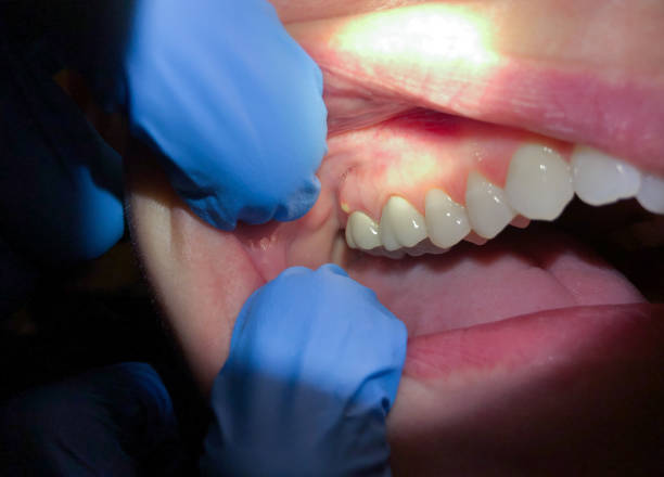 Best Emergency Care for Gum Disease in Crest Hl, IL